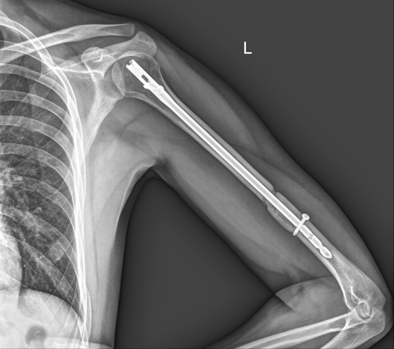 Операция после перелома плеча. Перелом диафиза плечевой кости. Перелом диафиза плечевой кости рентген. Перелом диафиза плечевой кости остеосинтез. Перелом шейки плечевой кости рентген.