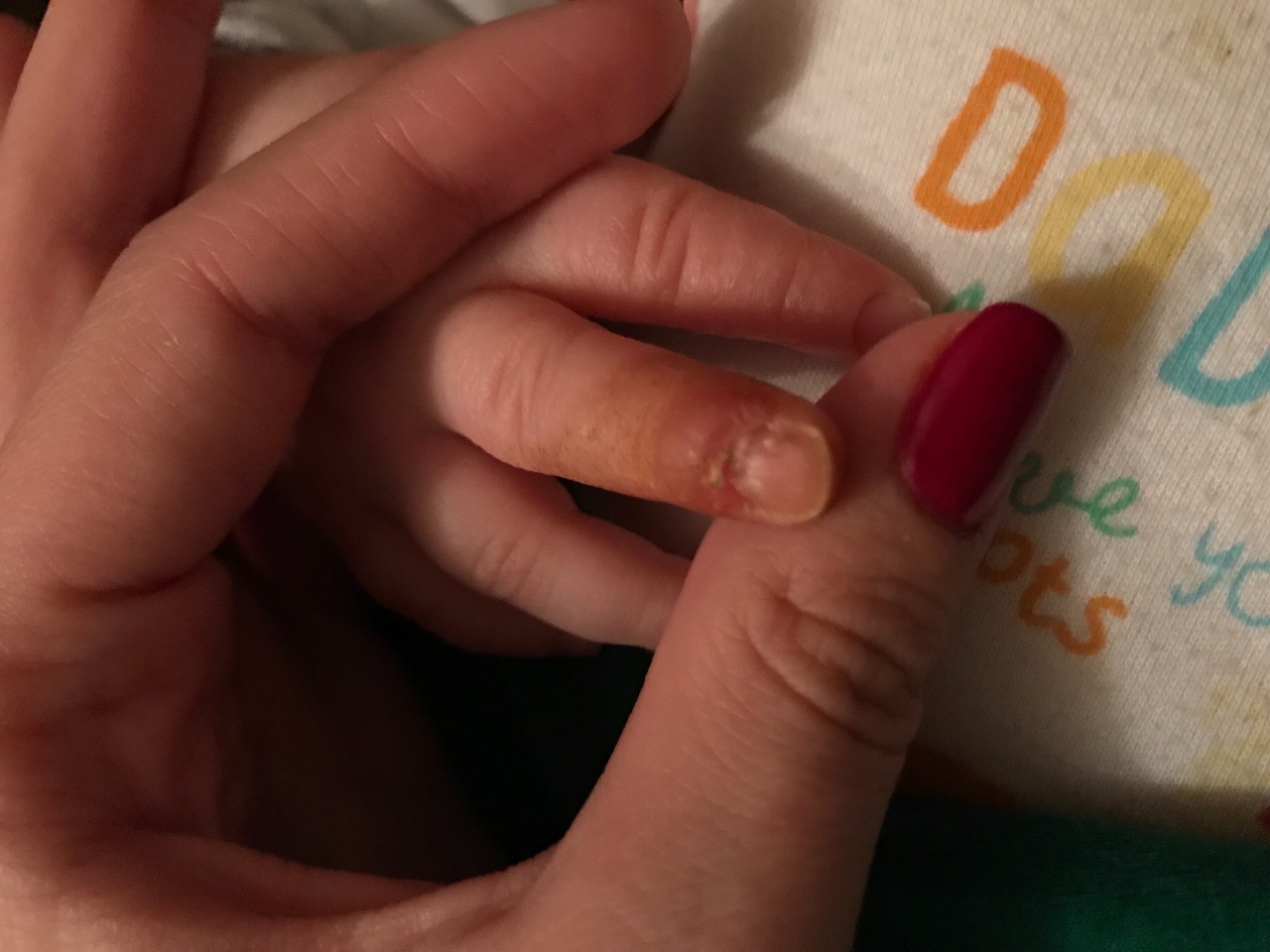 Панарица у ребенка на пальце
