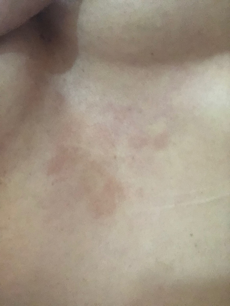 покраснение кожи на груди у женщин фото 16
