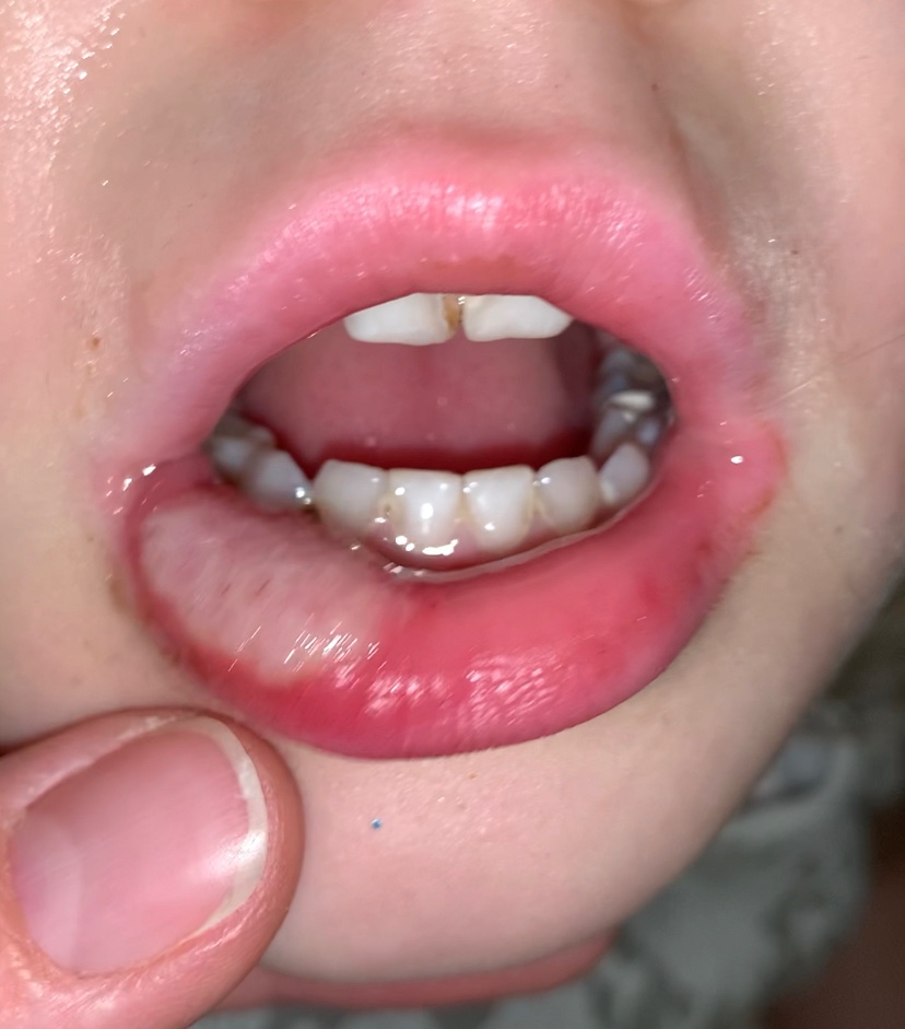 ребенок 4 лет искусал всю губу после анестезии.