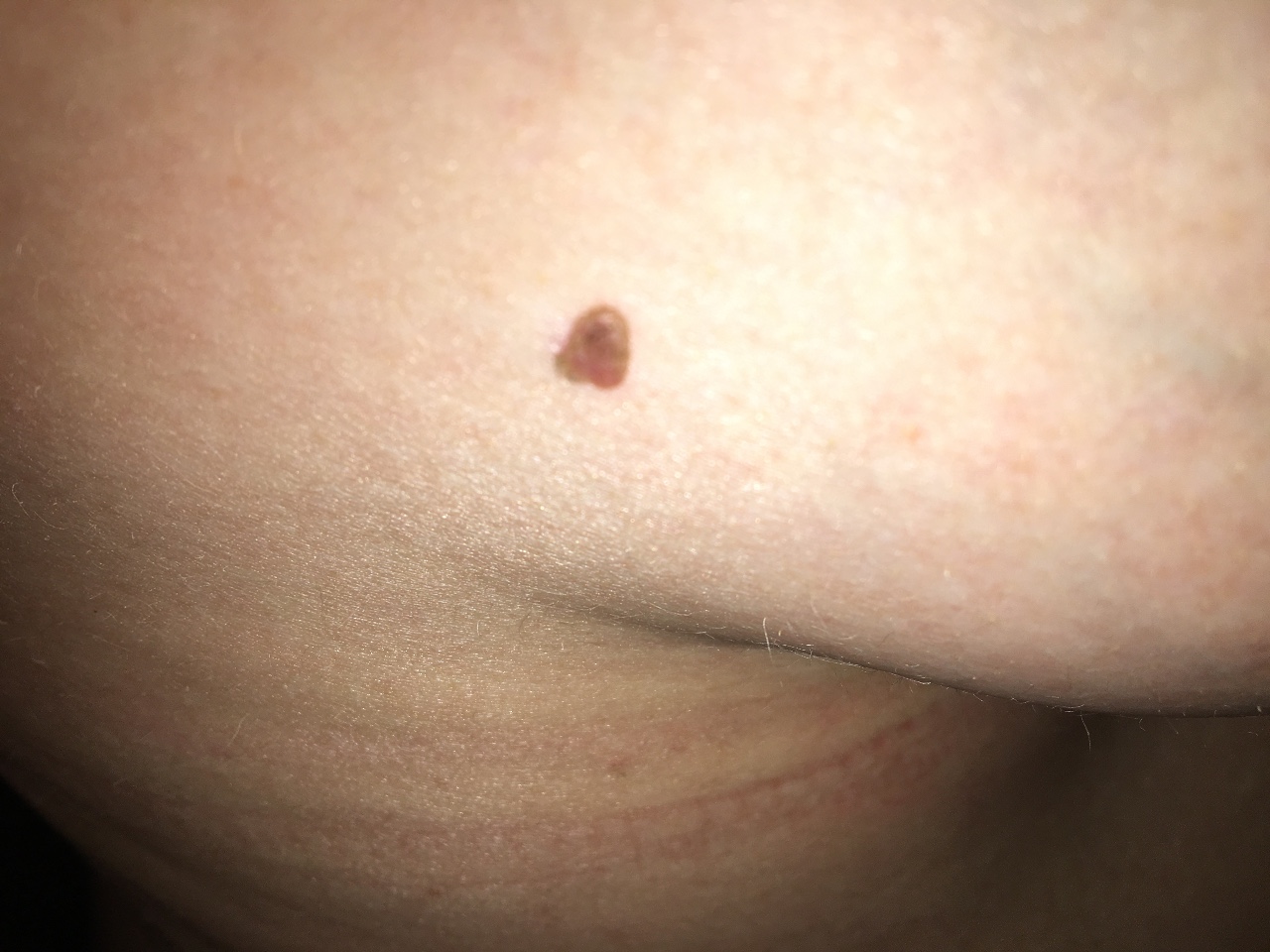 папилломы на груди беременной (120) фото