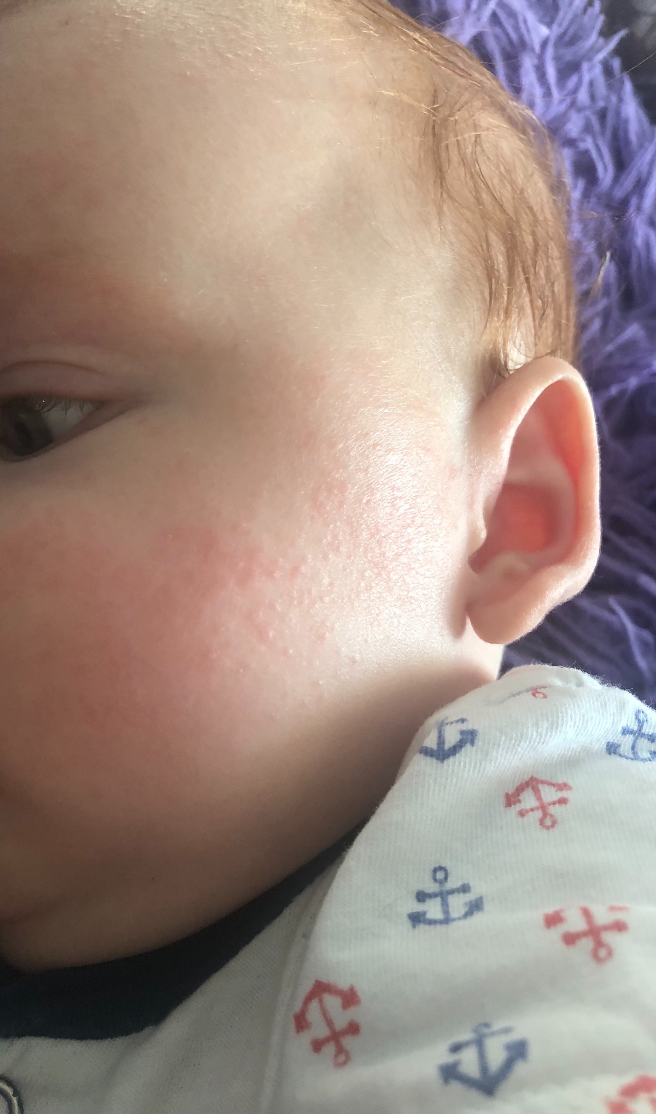 Мелкая сыпь на лице у ребенка