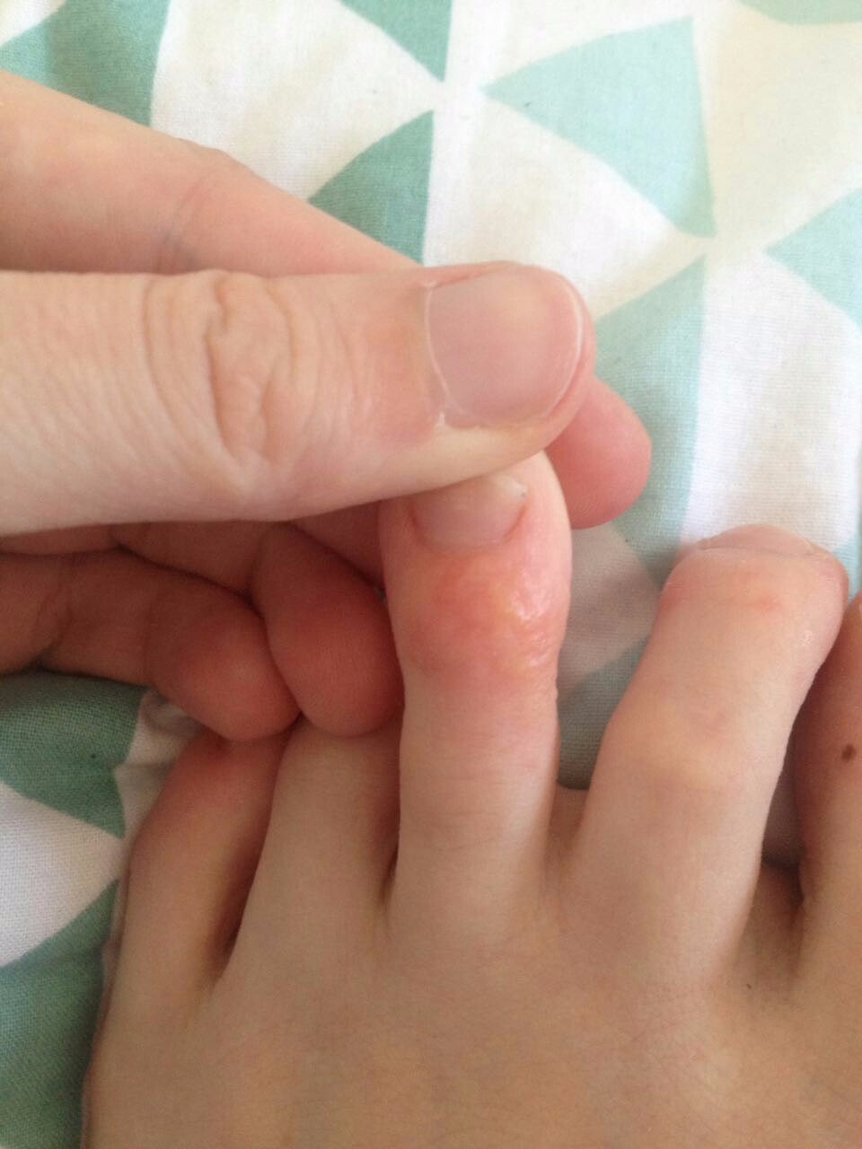 Сыпь между пальцами ног у ребенка