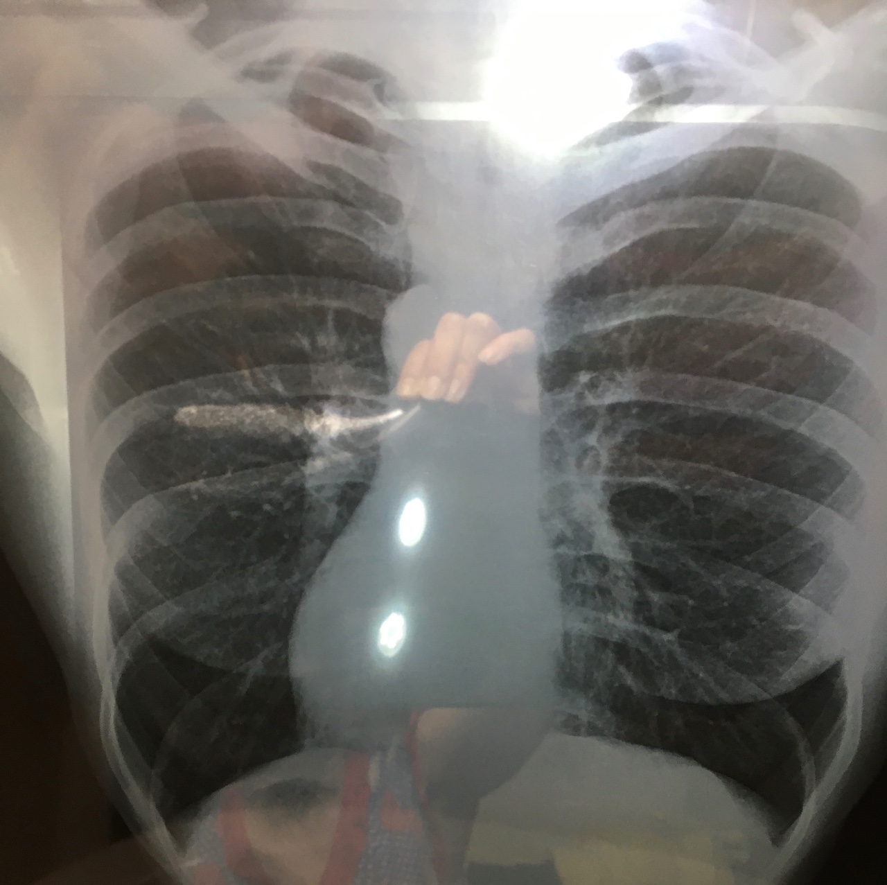 Пневмония при ковид 19 рентген
