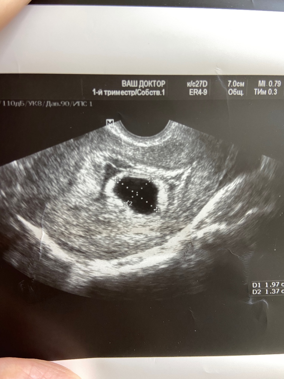 6 эмбриональная неделя. Анэмбрионии выделения.