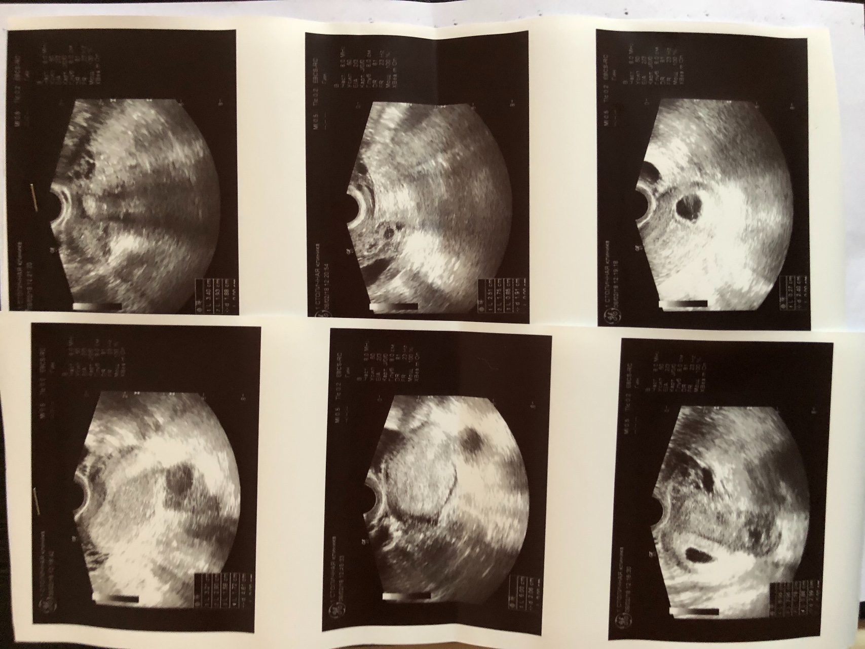 Анэмбриония на 5 неделе беременности
