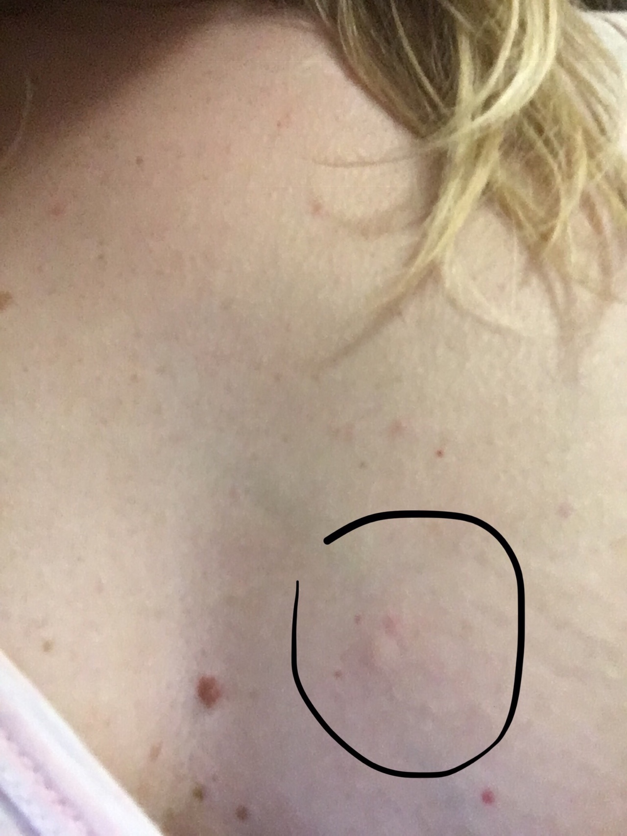 гнойная шишка на груди у женщин фото 86