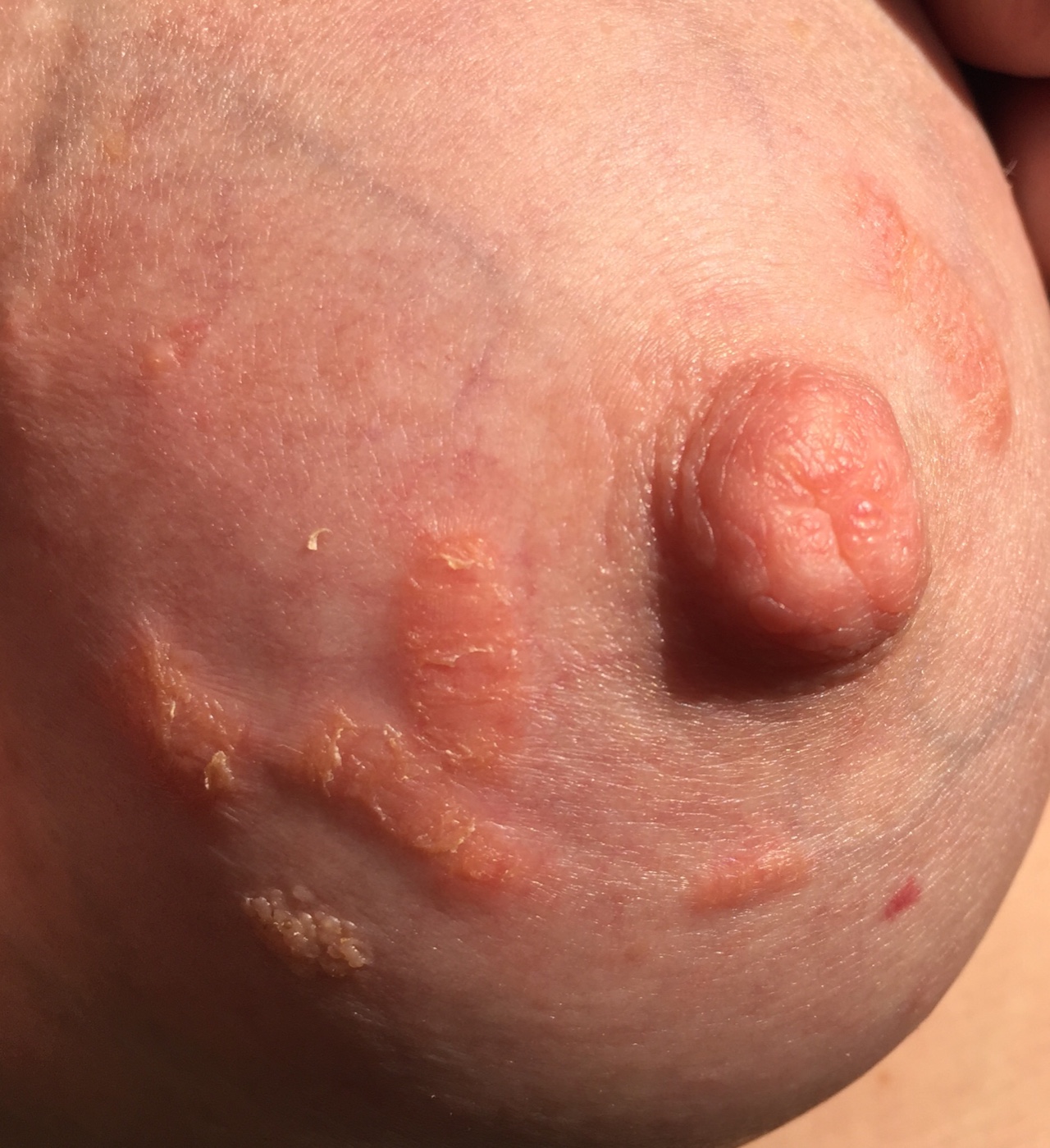 гиперемия груди у кормящих женщин фото 12