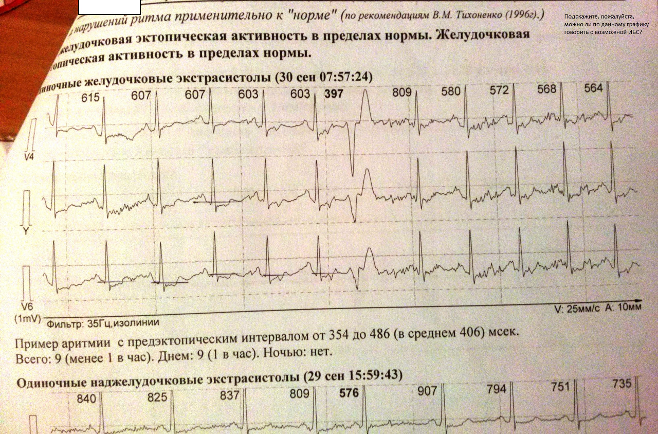 Расшифровка экг по фото бесплатно