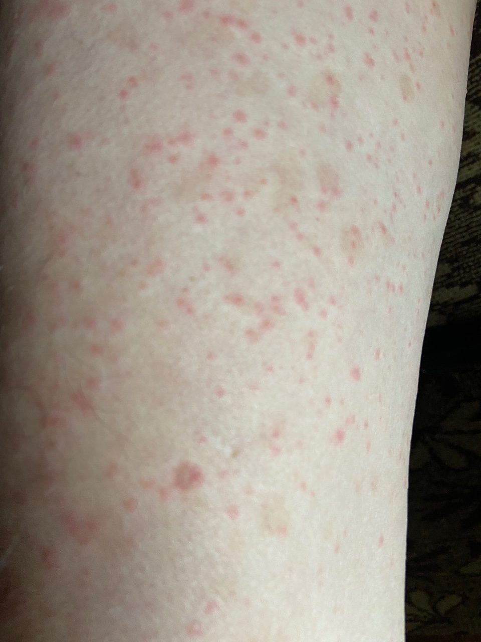 аллергия по телу по сперму фото 36