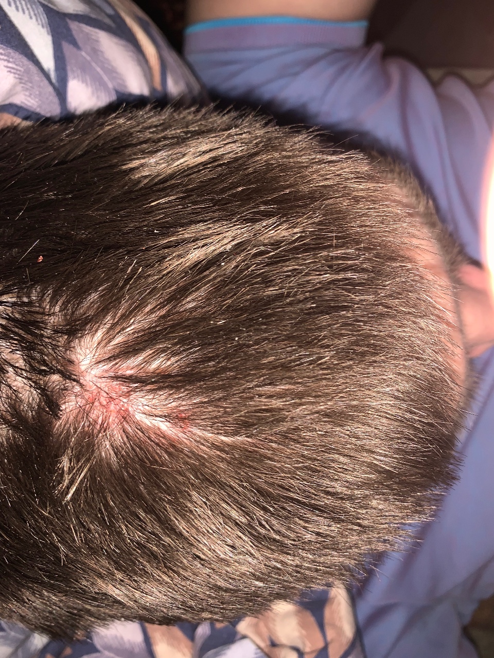 фото заболевания волосистой части головы у виска