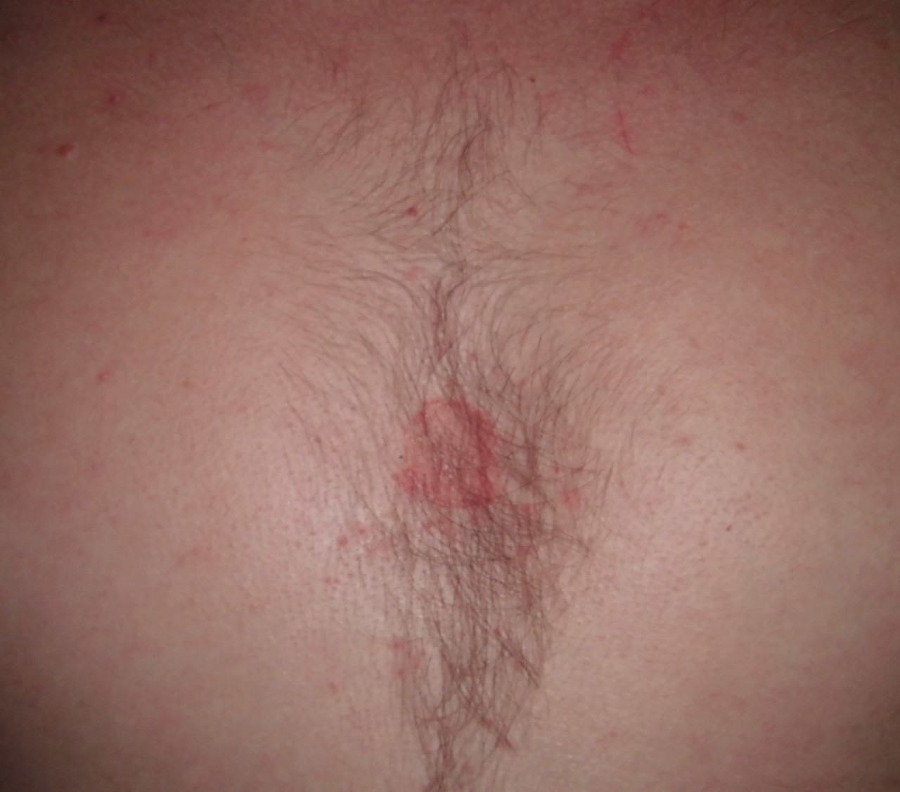 красные пятна между груди у мужчин фото 3