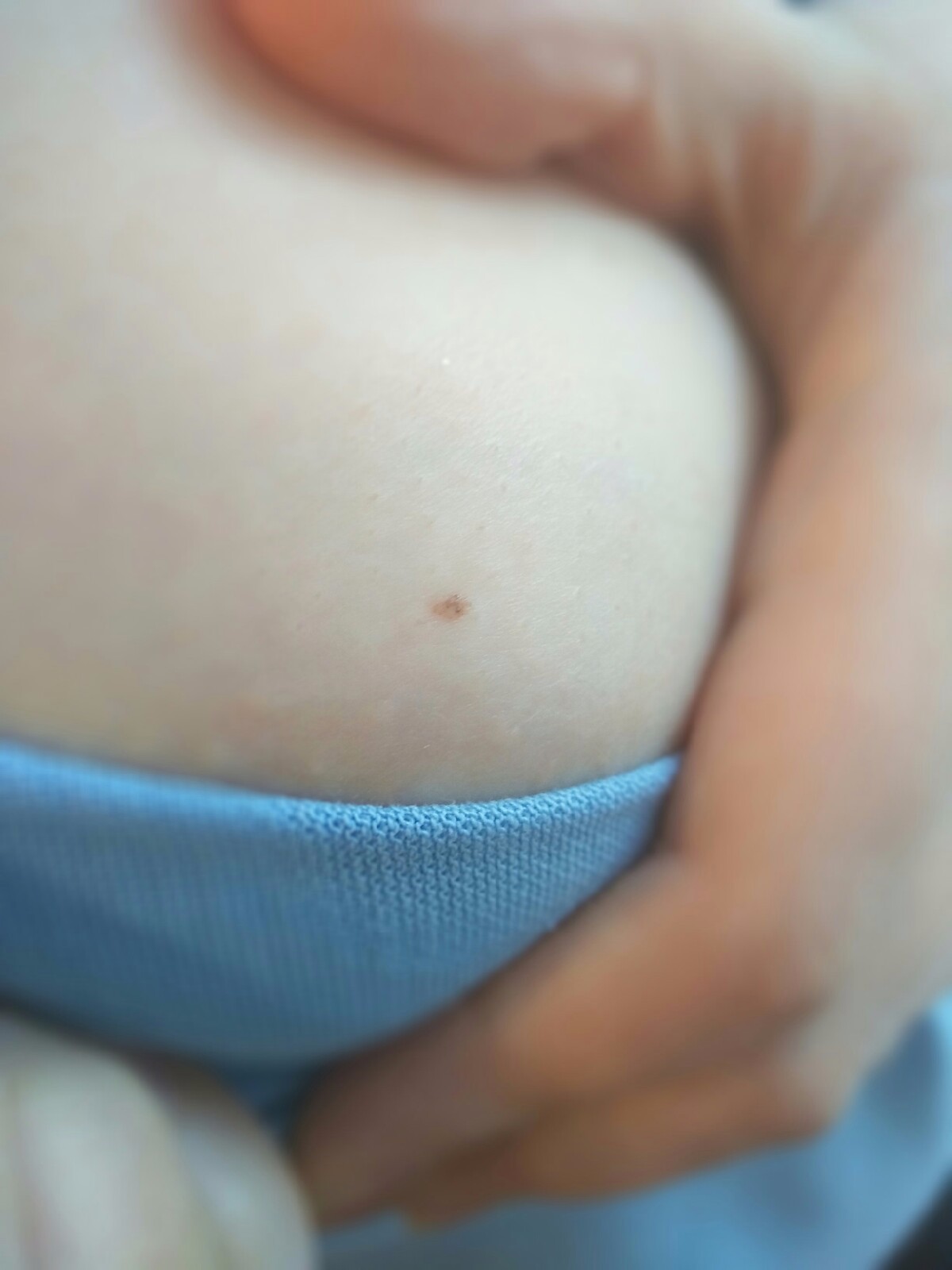 светлые пятна на груди женщин фото 72