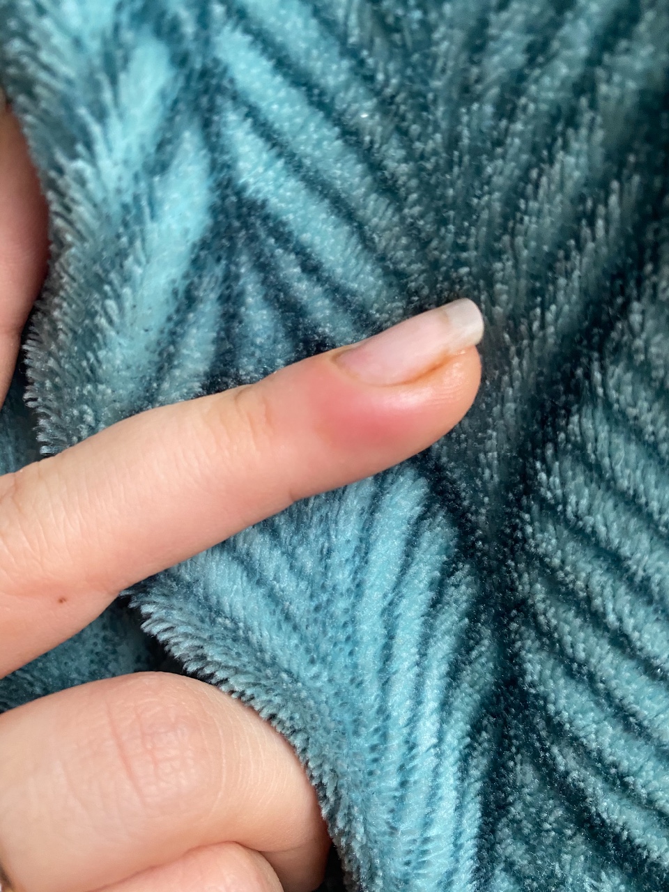 Панариций на пальце руки - Вопрос хирургу - 03 Онлайн