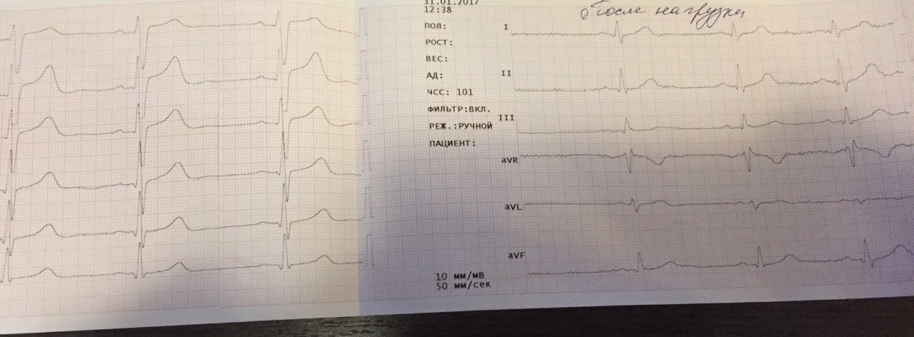 Аритмия на экг фото