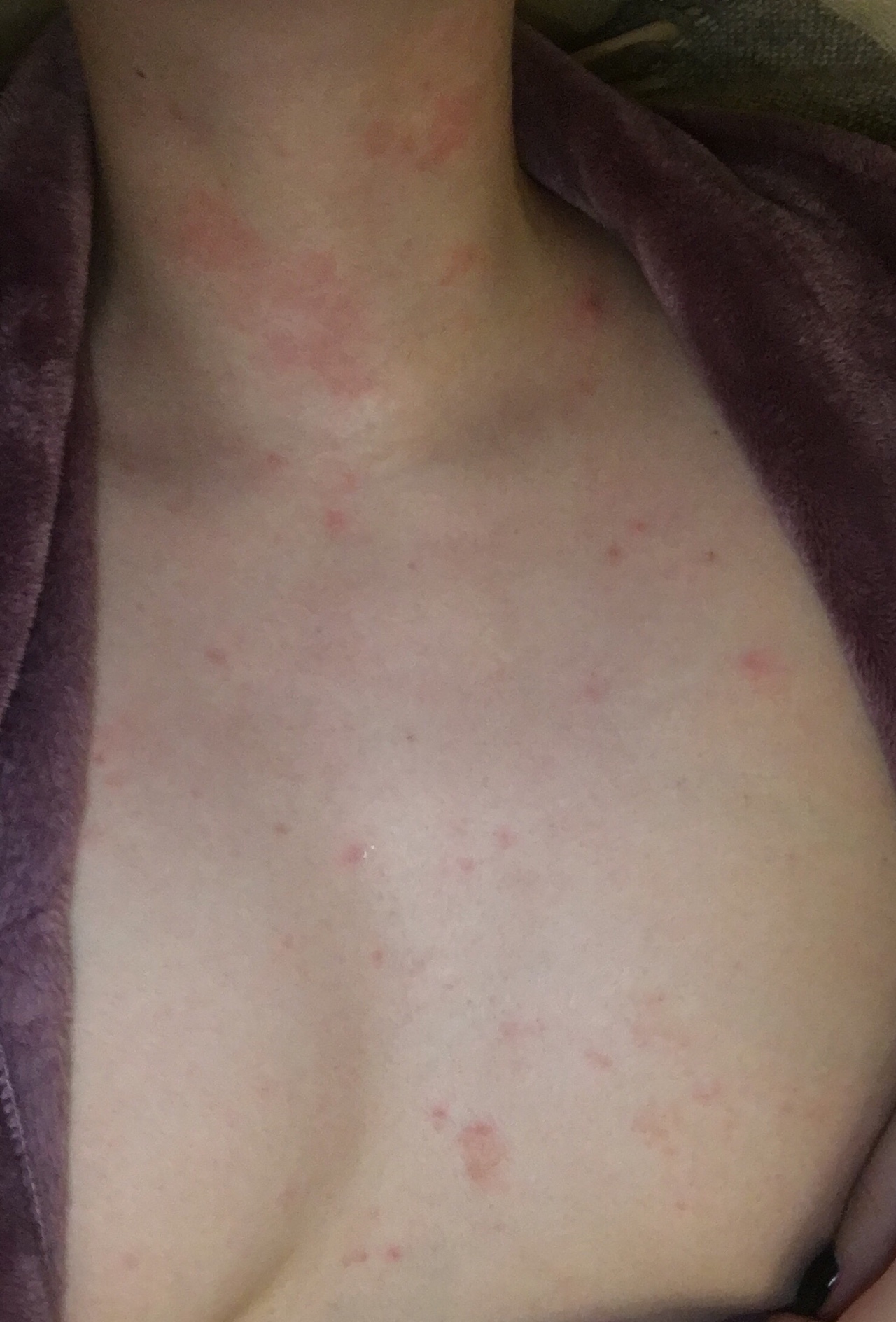 кожные высыпания на груди у женщин фото 114