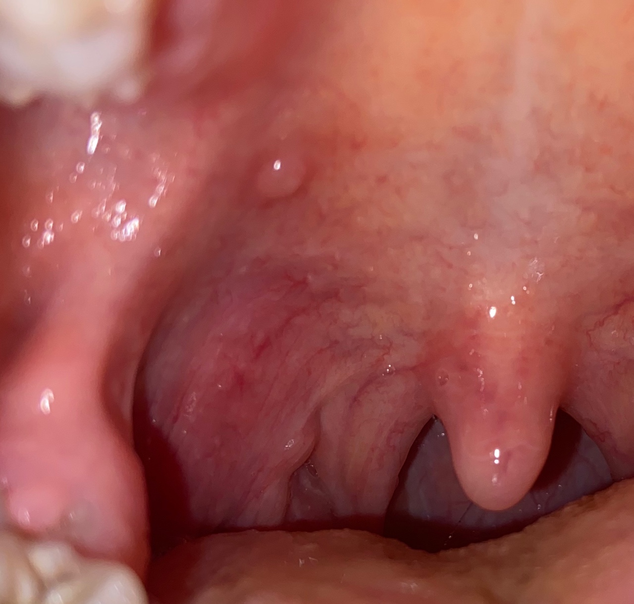 Воспаление во рту: симптомы, лечение и профилактика