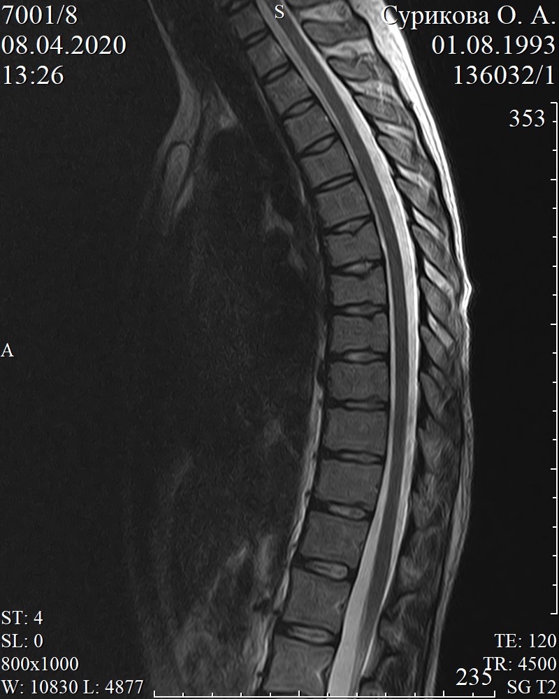 Мрт грудного. Мрт грудного отдела позвоночника остеопороз. Мрт грудного отдела. Гемангиома позвоночника грудного отдела. Остеохондроз грудного отдела мрт.