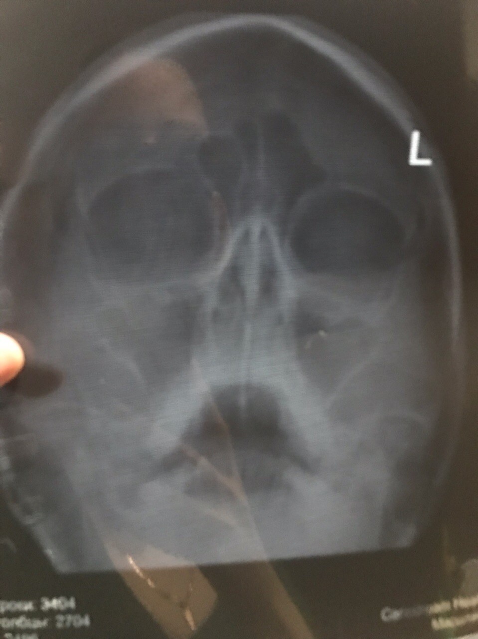 Рентген носа здорового человека