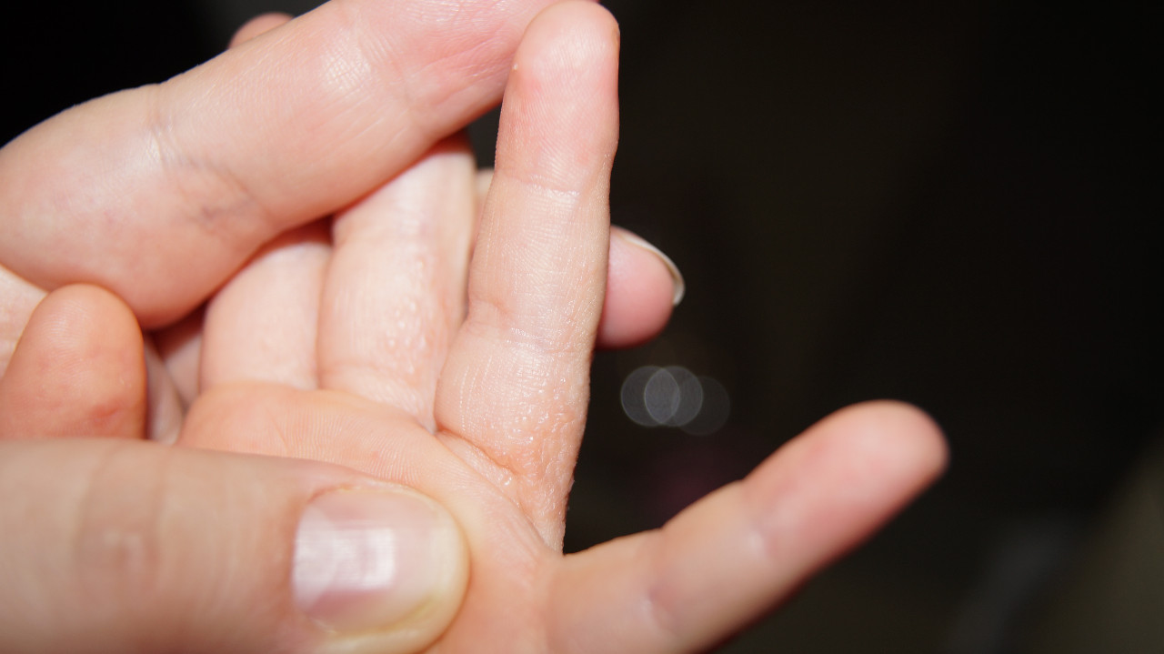 Пузырьки на коже чешутся водяные пузырьки на руках фото лечение