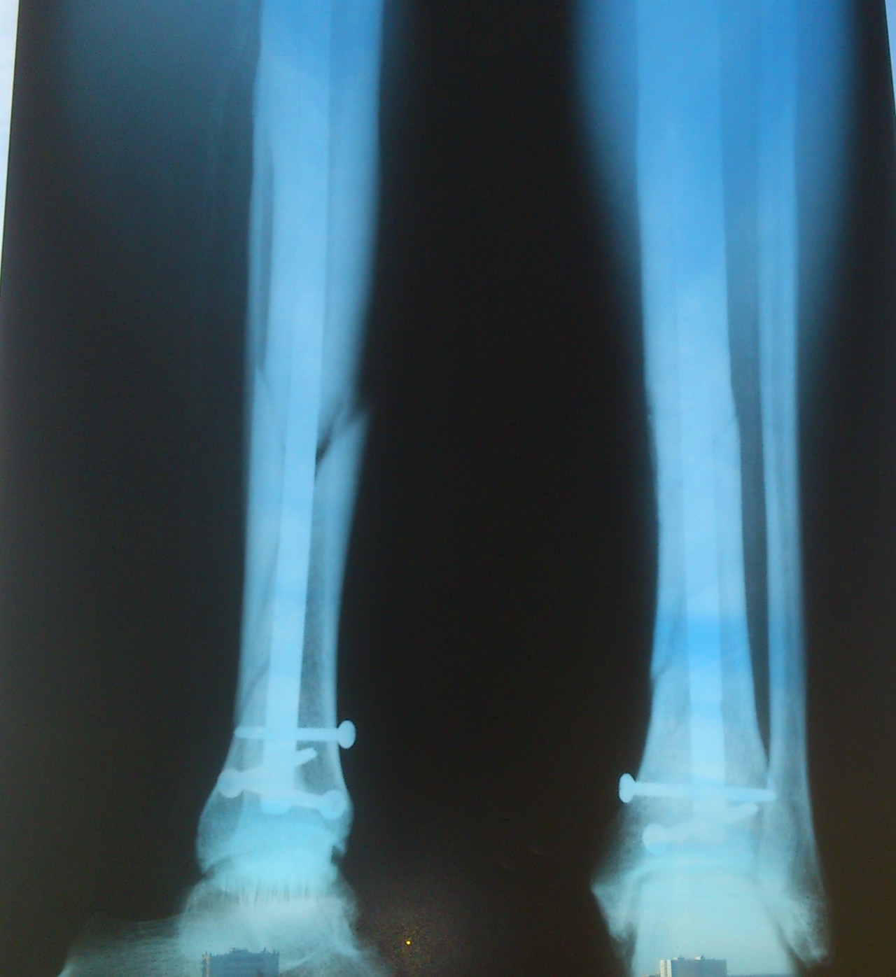 Сросшийся перелом костей голени рентген