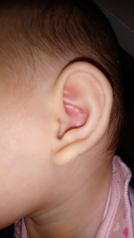 Причины торчащих ушей