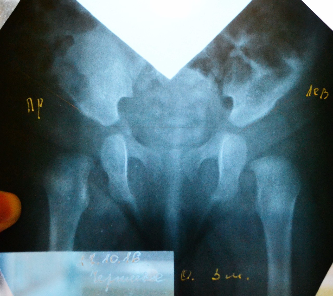 Что такое тбс. Дисплазия тазобедренных суставов рентген 3 месяца. Норма рентгена тазобедренных суставов в 3 месяца. Рентген тазобедренных суставов 7 месяцев.