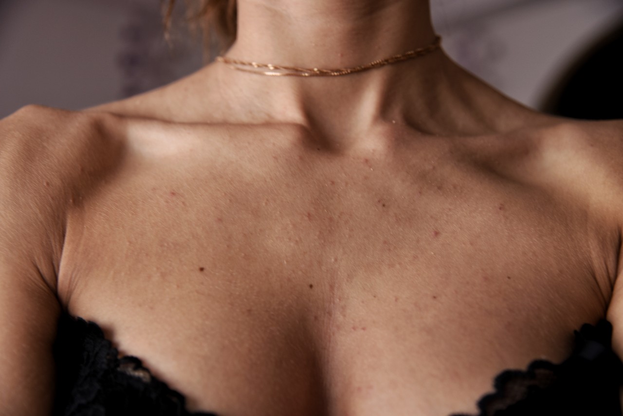 красная сыпь на груди у женщин фото 30