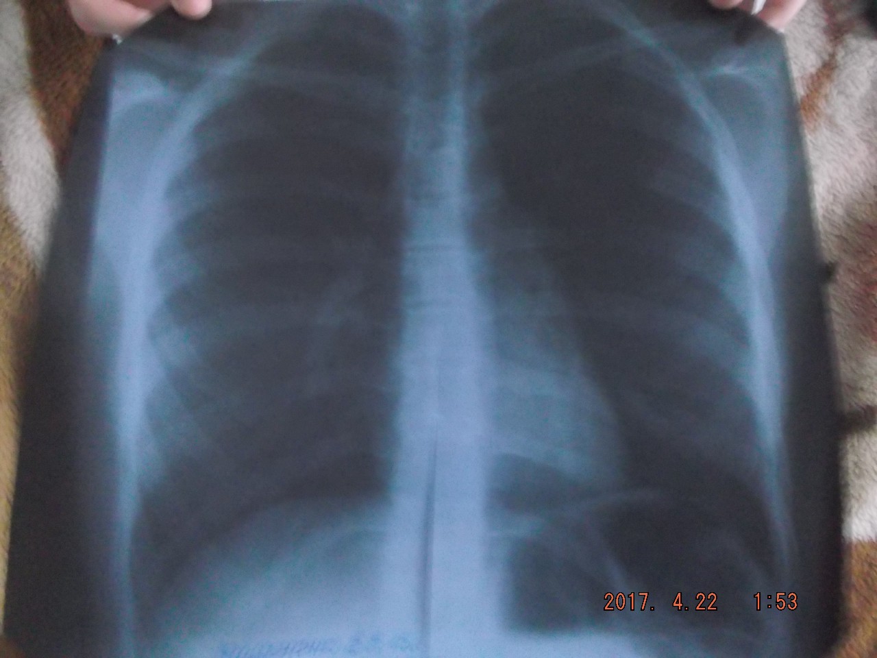 Припухлость ребра слева. Рентген перелом ребра слева. Рентгеновские снимки переломов ребер. Снимок сломанных ребер рентген.