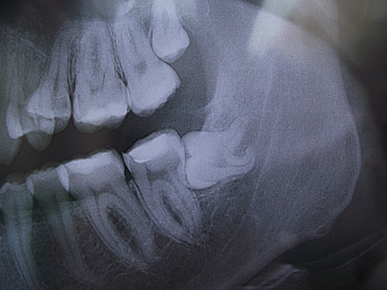 Зуб мудрости рентген снимок