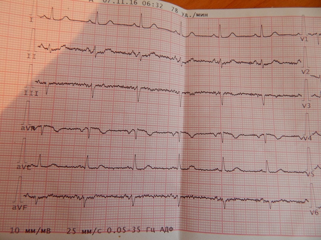 Как выглядит кардиограмма сердца здорового человека фото