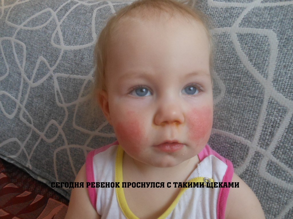 У ребенка горят щеки. Красное пятно на щеке у ребенка.