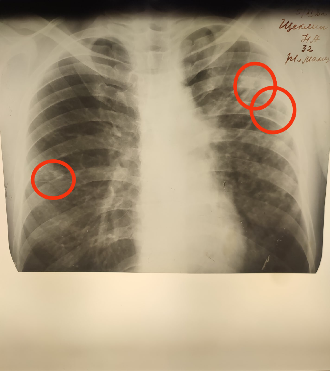 Метатуберкулезное изменение легкого. Туберкулезный снимок легкого рентген. Туберкулёз лёгких на рентгене.