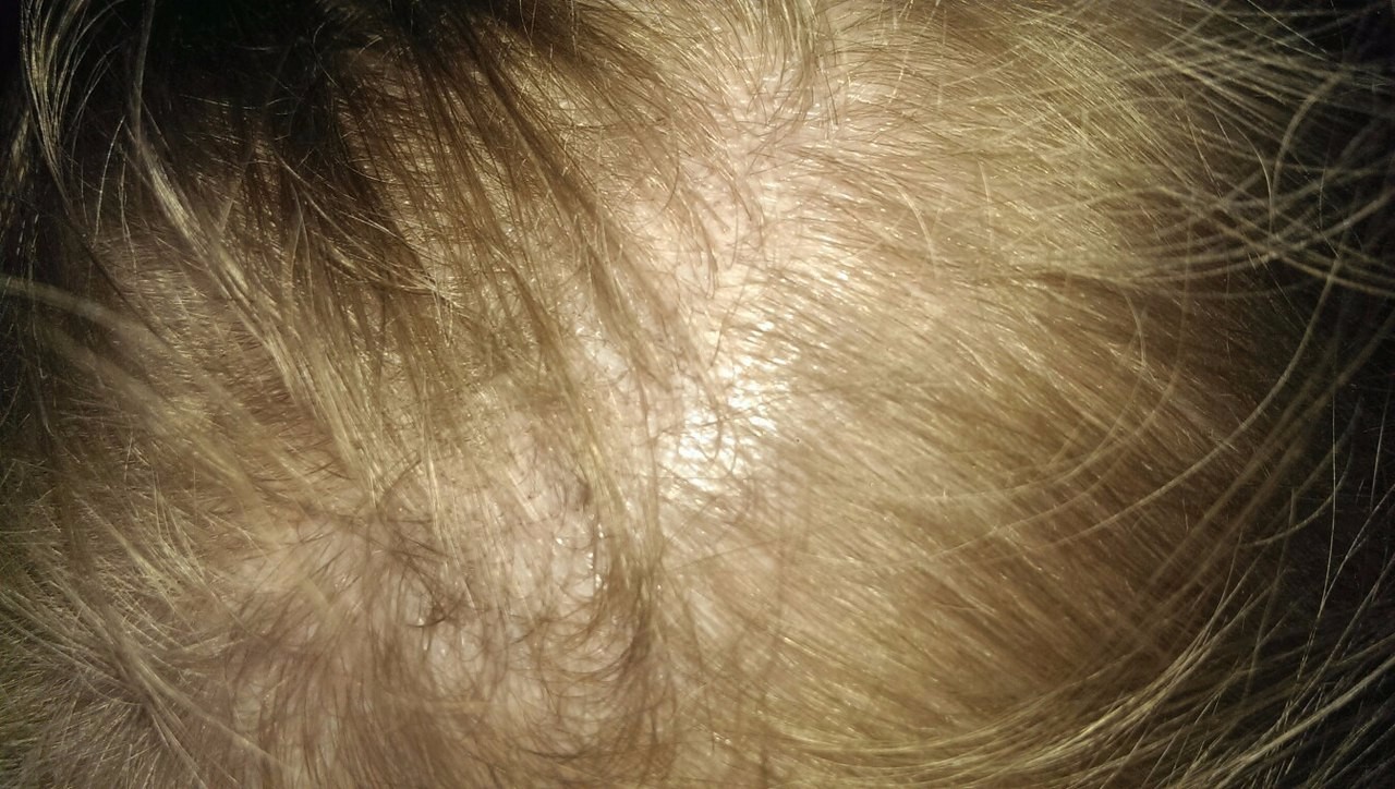 Выпадение волос при желтухе