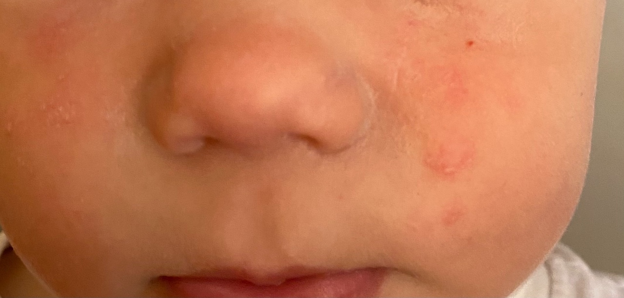 Как выглядит аллергия у детей фото