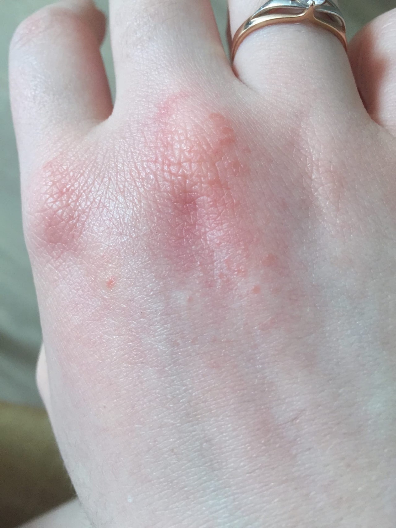 Мелкая сыпь на руках с зудом Вопрос дерматологу 03 Онлайн