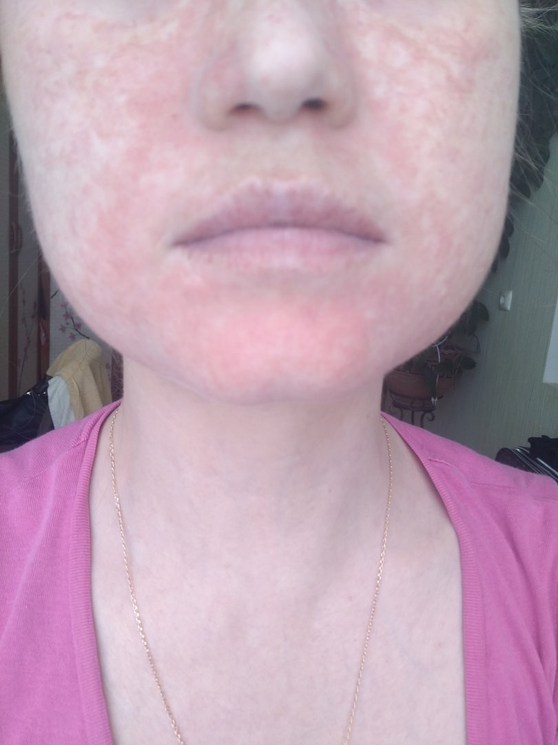 Сыпь на лице, жжение - Вопрос дерматологу - 03 Онлайн