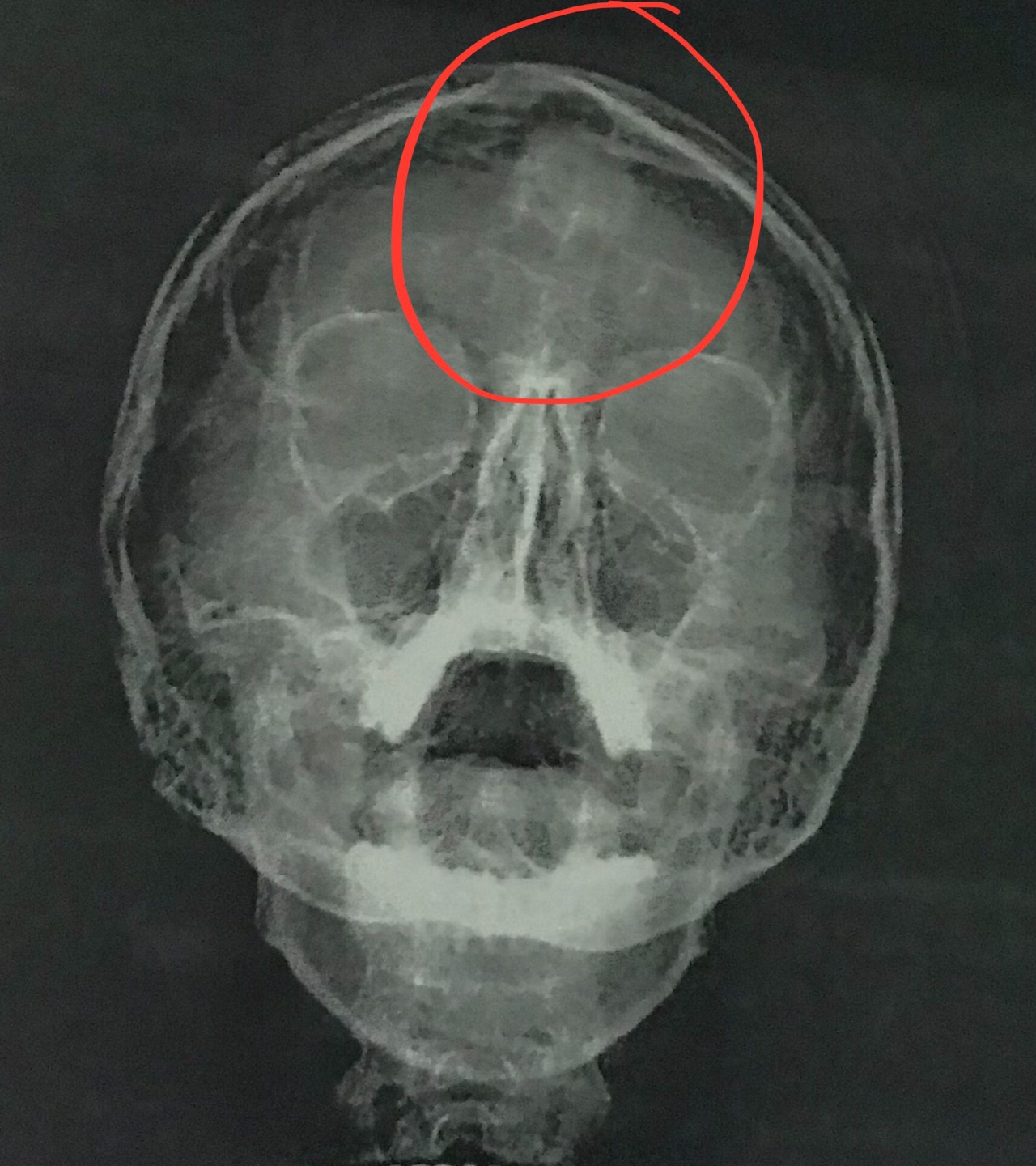 Рентген пазух носа фронтит