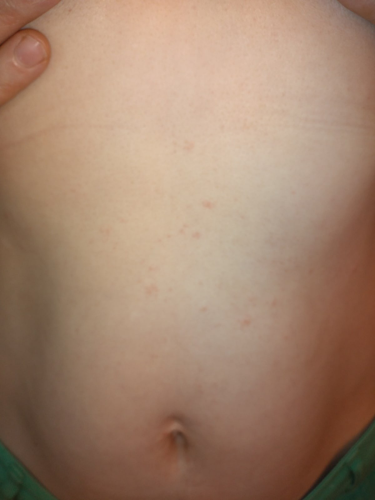 сыпь на грудях во время беременности фото 117