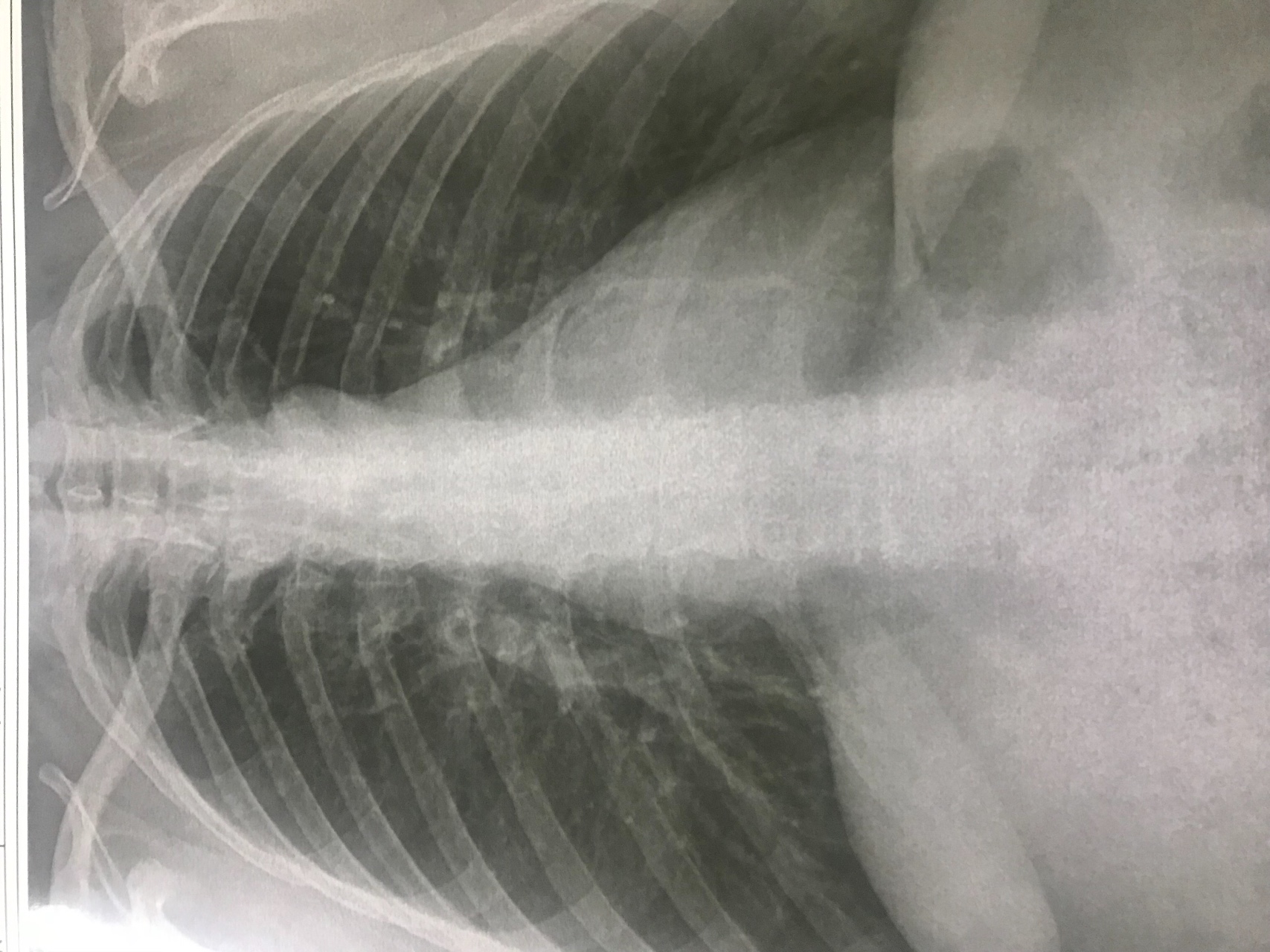 воспаление легких на рентгене фото