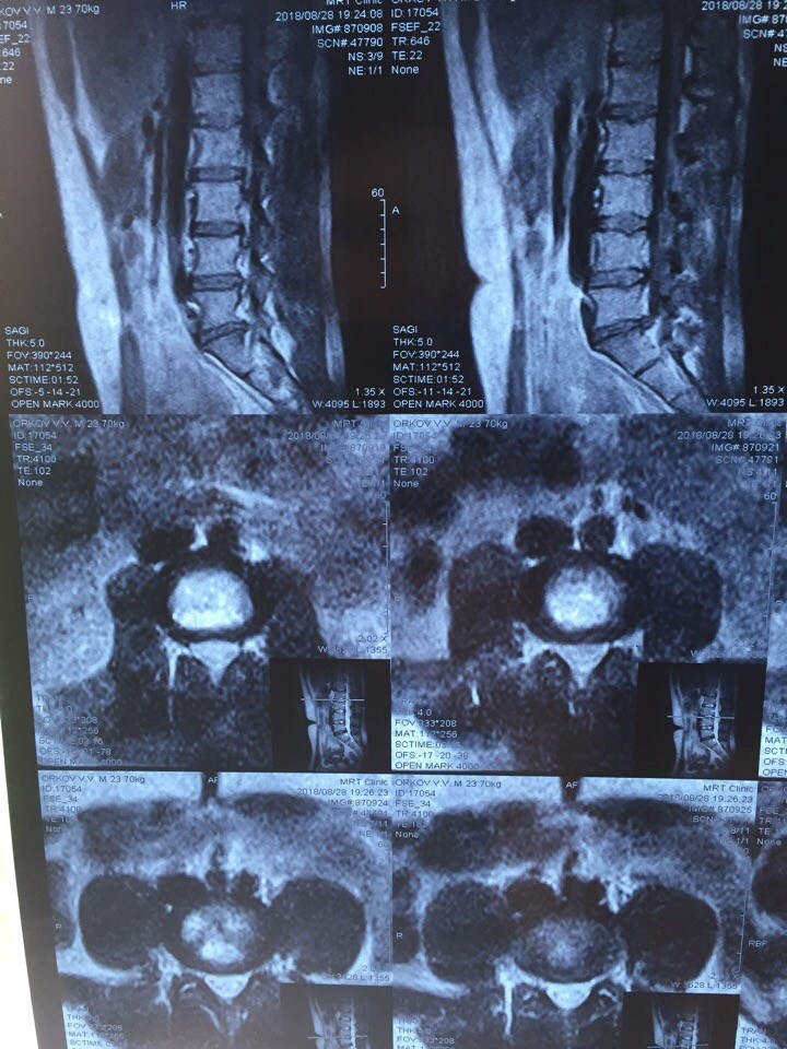 Нейрохирург грыжа поясничного отдела