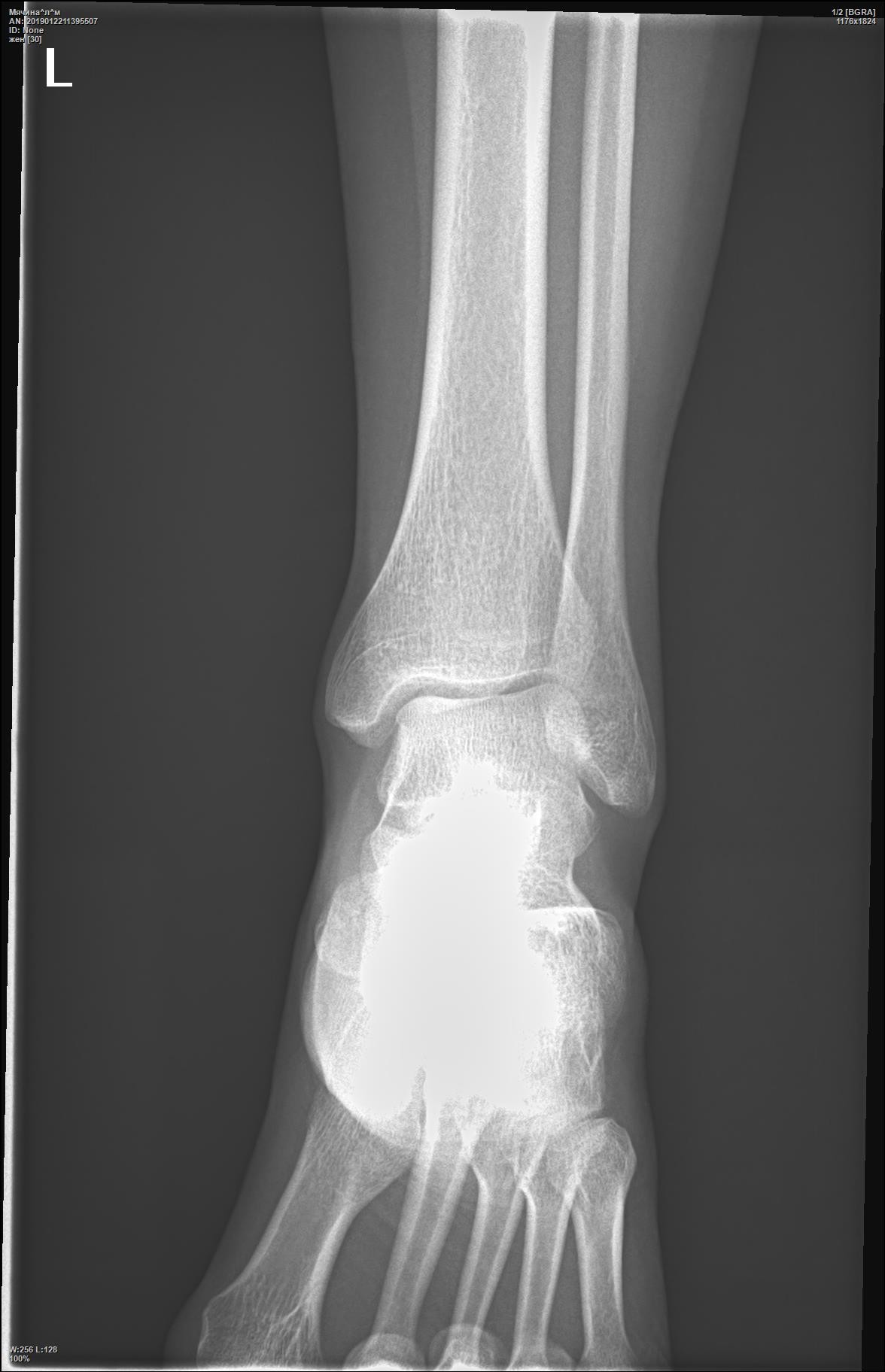 Трещина кости на ноге. Перелом латеральной лодыжки рентген. Краевой перелом наружной лодыжки. Краевой перелом лодыжки. 3 Краевой перелом наружной лодыжки.