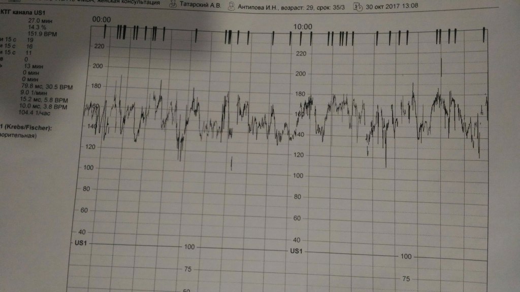 Ктг при беременности что это. Нормальная диаграмма КТГ. Нормальный Тип КТГ расшифровка. КТГ при беременности диаграмма. КТГ аппарат с расшифровкой.