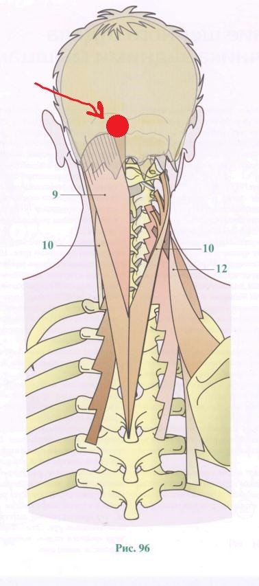 Причины боли у основания черепа. Шишечка задней части головы и шеи. Шишечка на задней части шеи. Выпирающач кость га заьвлке.