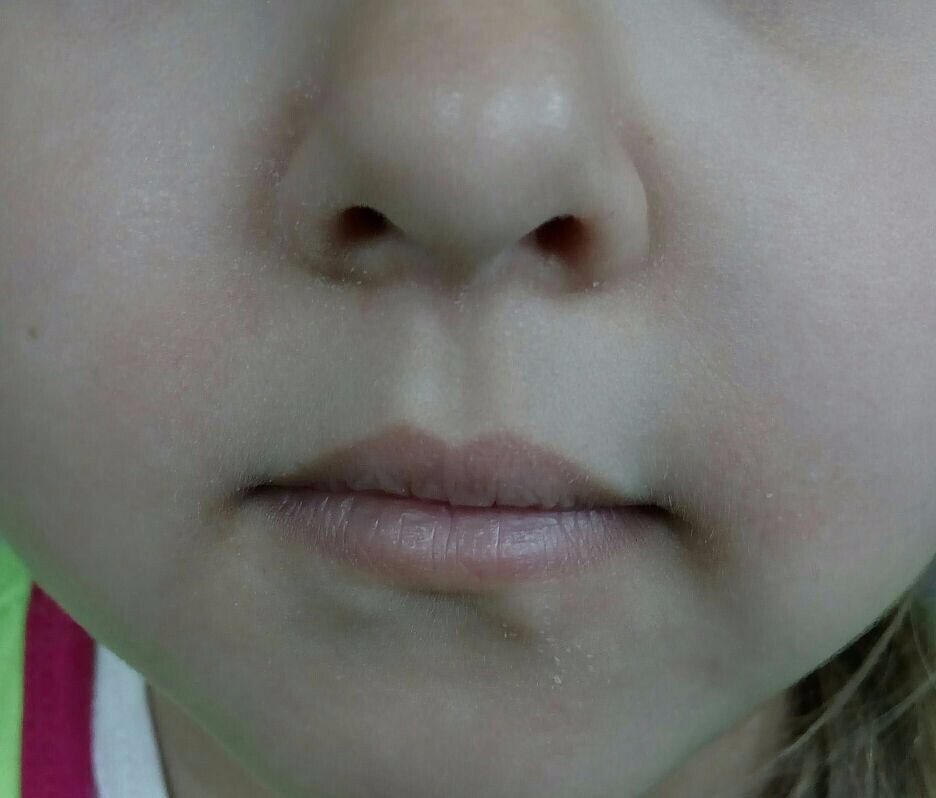 Контактный дерматит у ребенка фото
