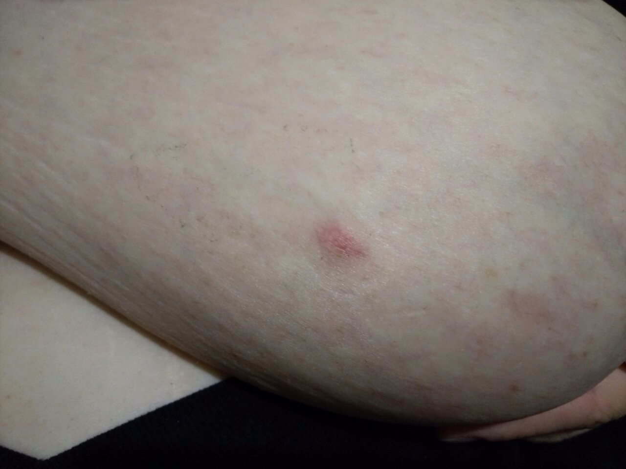 красные точки на груди при беременности фото 5