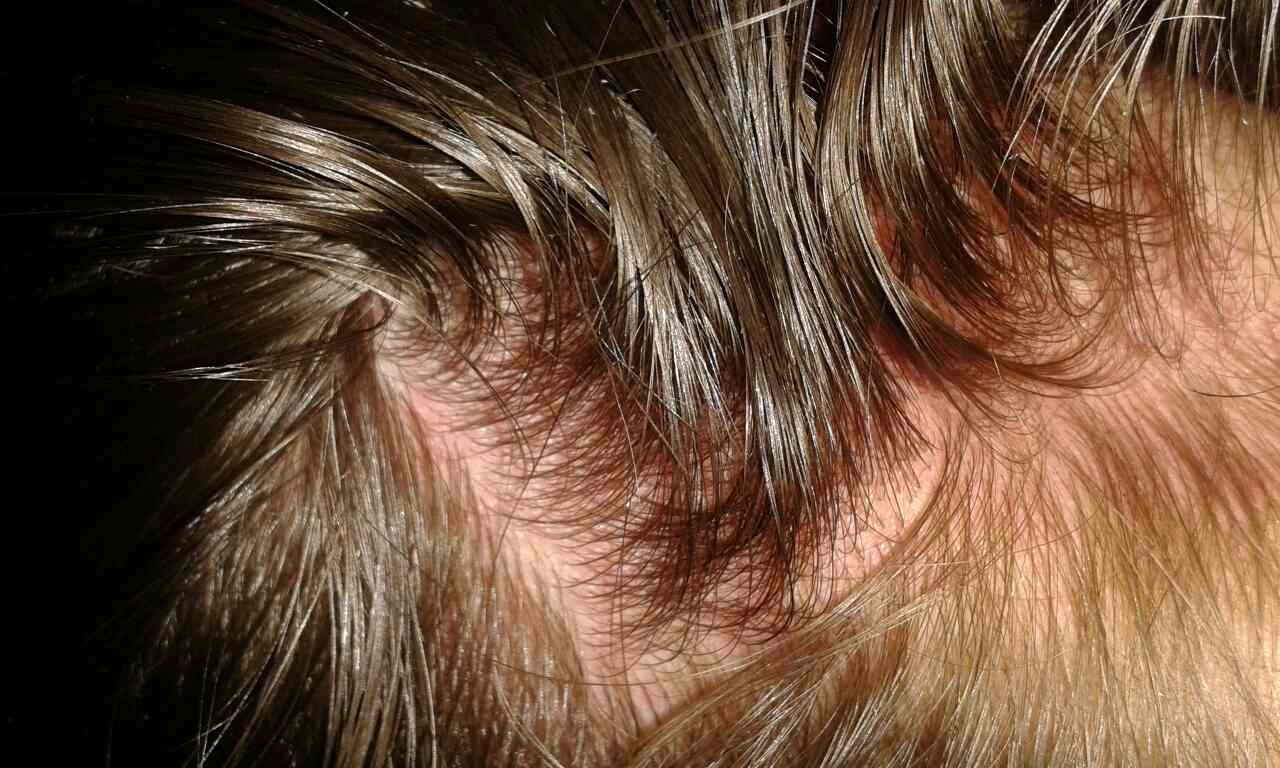 Почему голова после наращивания волос чешется голова