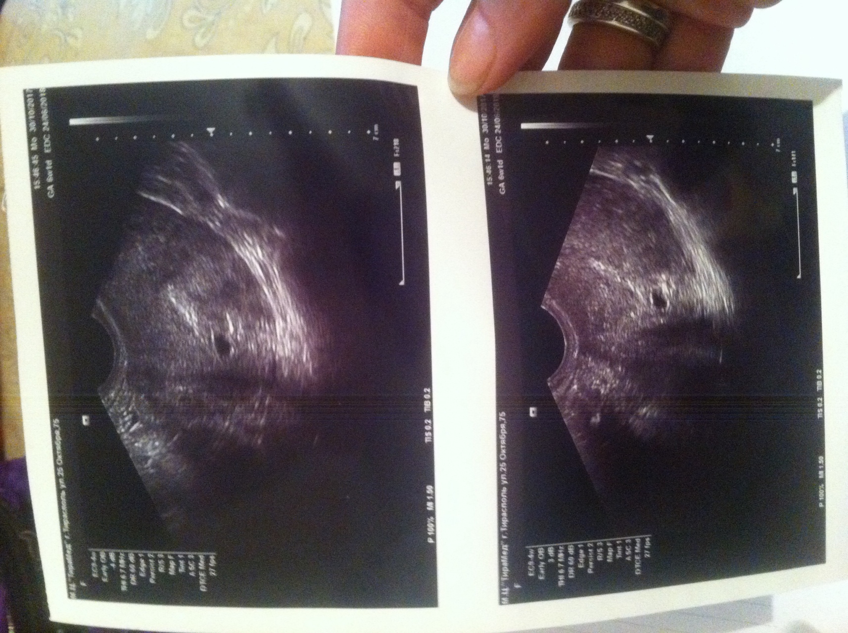 замершая беременность признаки грудь фото 41