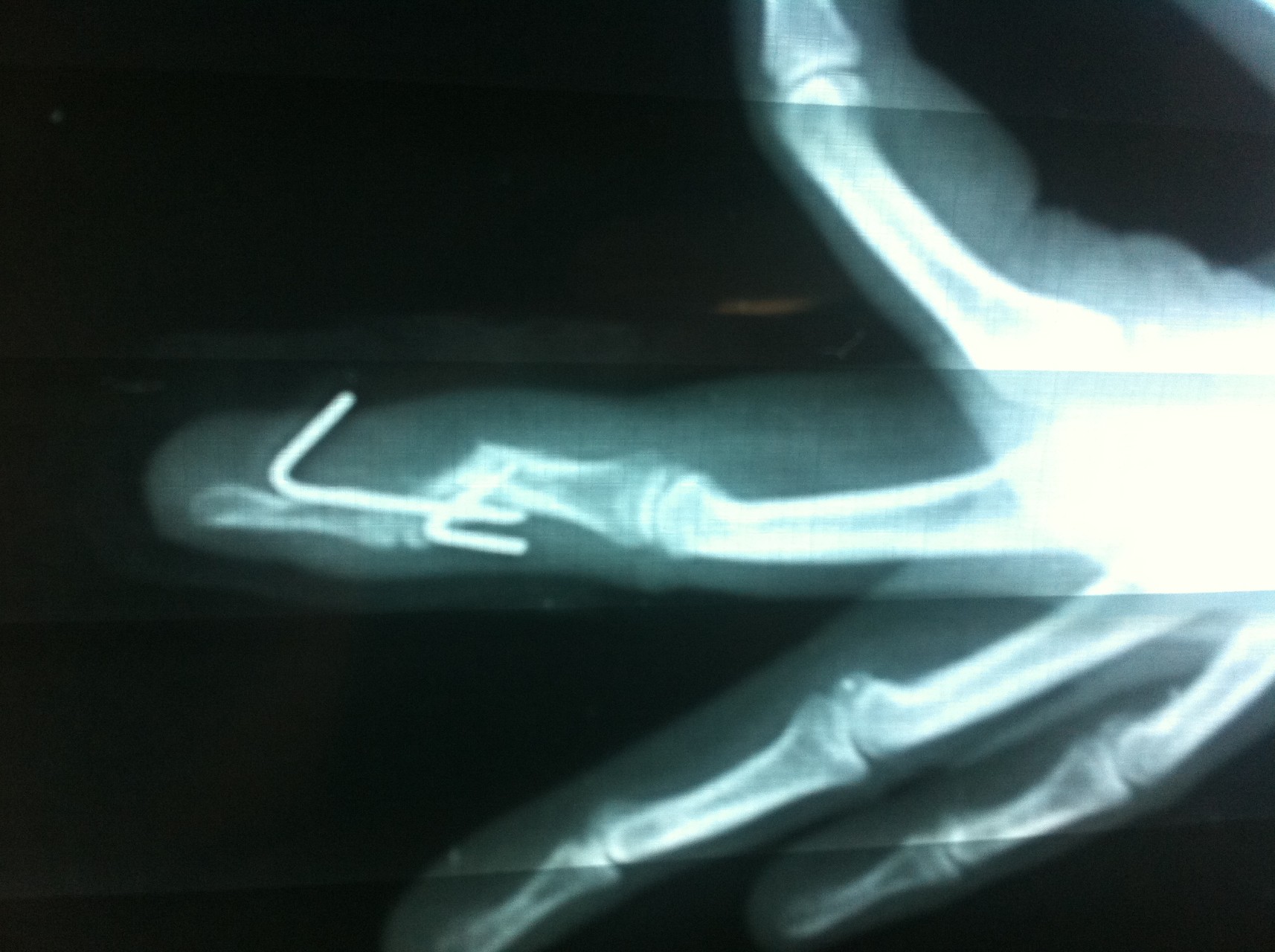 Остеотомия фаланги пальца кисти. Титан срастается с костью. Сращение костей предплечья между собой врождённое.
