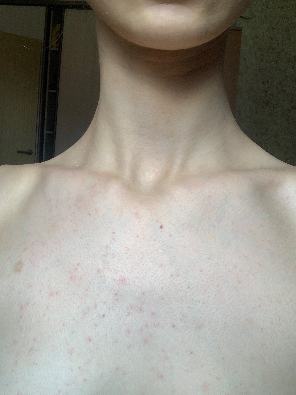 сыпь на груди и шее у женщин причины фото 116